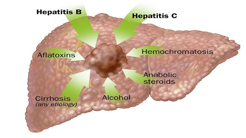 grant-funds-collaborative-project-to-find-new-treatments-for-liver-cancer